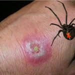 black widow spider bite pictures & symptoms (3)