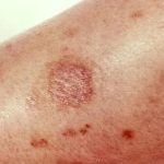 brown recluse spider bite stages pictures (2)
