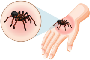 how to treat a spider bite at home